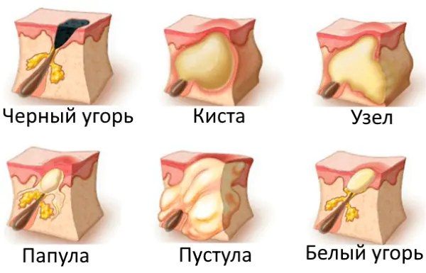 pochemu-u-devushki-pryshi-na-BoSYnb.webp