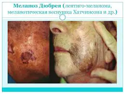 priznaki-melanomy-na-lice-EhzNTV.webp