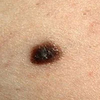 priznaki-melanomy-na-lice-OcFXkBB.webp
