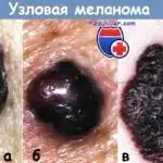 priznaki-melanomy-na-lice-UIsSIF.webp