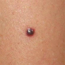 priznaki-melanomy-na-lice-klJRFH.webp