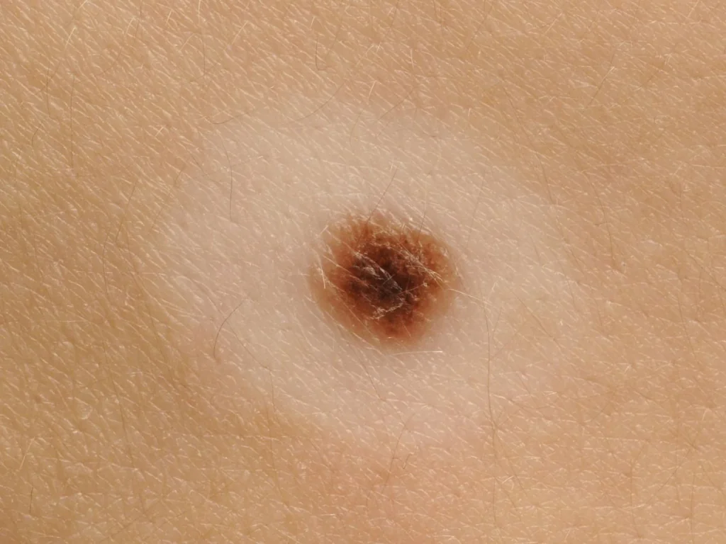 priznaki-melanomy-na-lice-pXcsqG.webp