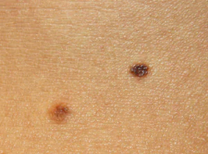 priznaki-melanomy-na-lice-rqJSriL.webp