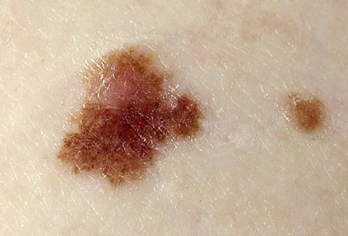 priznaki-melanomy-na-lice-yIWVL.webp