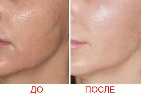 procedimiento-dlya-podtyazhki-BmucF.webp