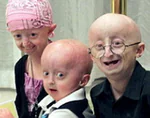 progeriya-eto-chto-takoe-fvCnSDS.webp