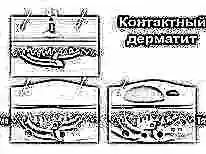 pyatnyshko-na-kozhe-u-rebenka-YQmdR.webp