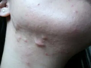 rubcy-posle-tratamiento-acné-MSDeI.webp