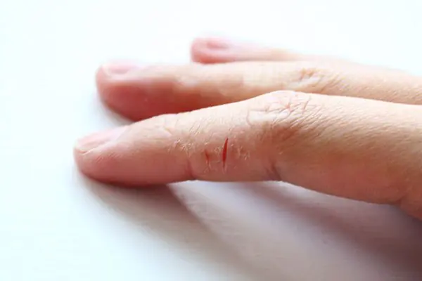 dry-skin-fingers-hands-CIbSn.webp
