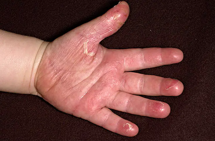 dry-skin-thumbs-hands-GkquNuP.webp