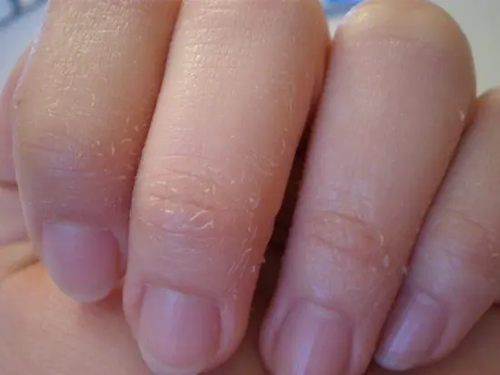 dry-skin-fingers-hands-LguINO.webp