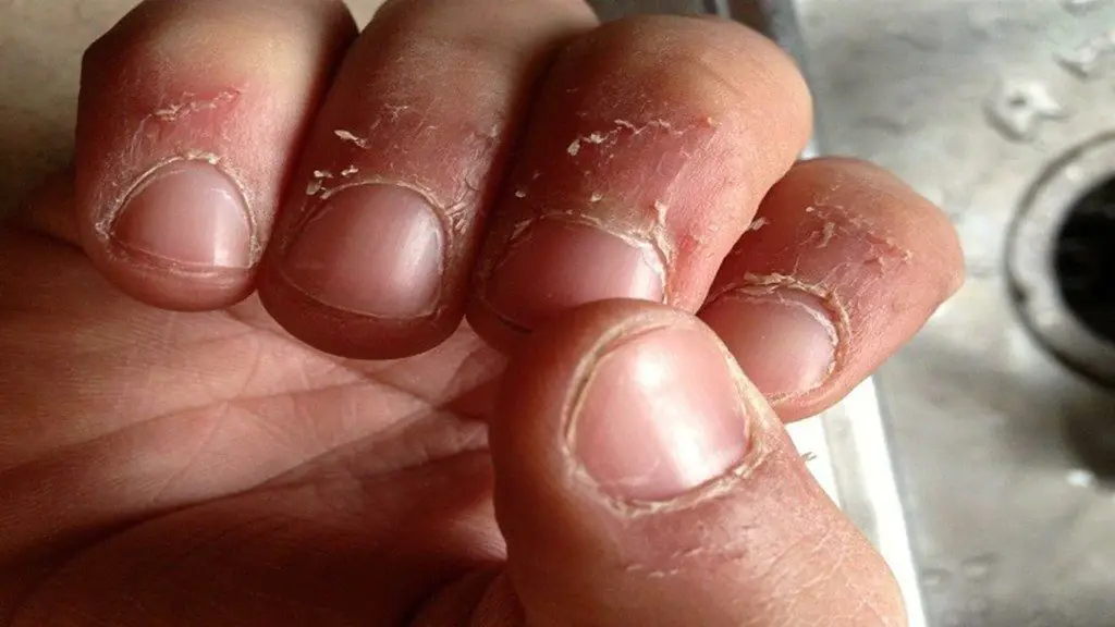 dry-skin-fingers-hands-VUaCEIN.webp