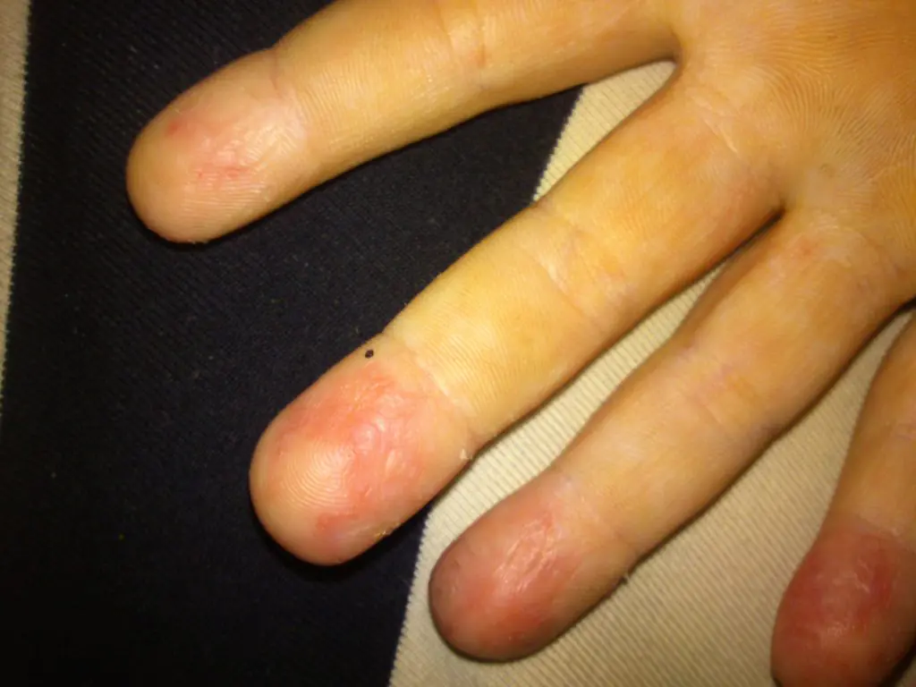 dry-skin-fingers-hand-czBiaIh.webp