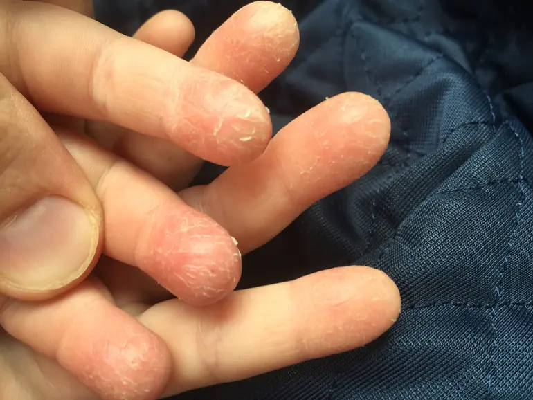 dry-skin-fingers-hands-sejNtvC.webp