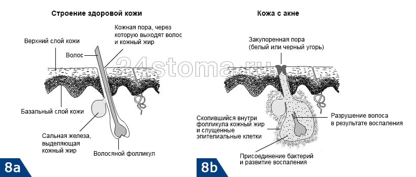 写真-devushek-s-pryshami-na-bXACmU.webp