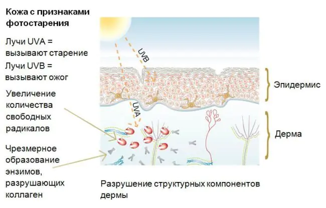 fotostarenie-kozhi-chto-eto-OtZS.webp