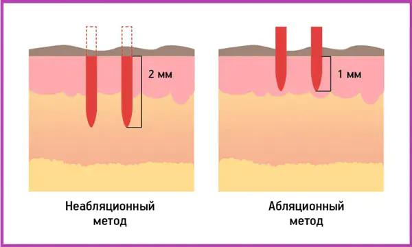 frakcionnoe-neablyaciónnoe-Tbe.webp