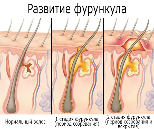 furunkulez-chto-eto-za-bolezn-Eni.webp