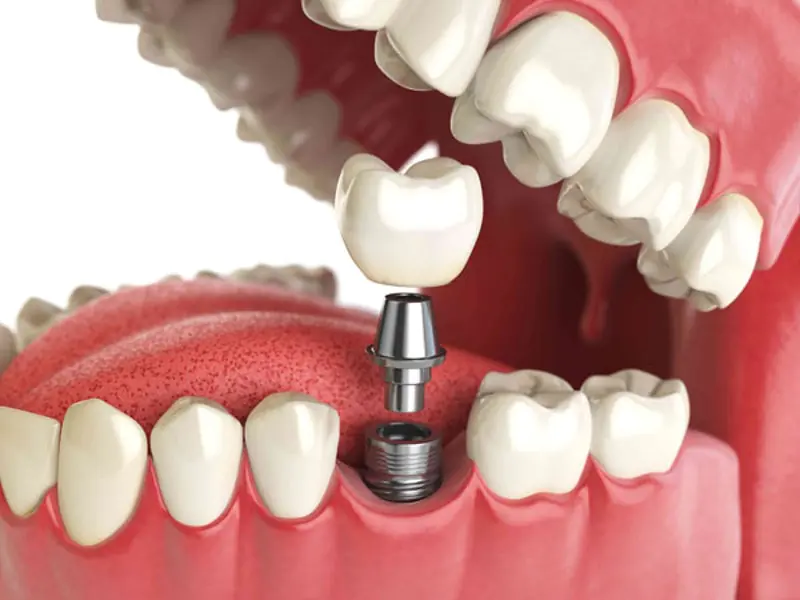 Implantación dental: indicaciones, etapas.