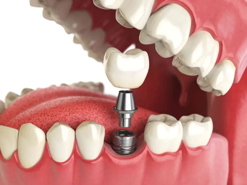 Tandheelkundige implantatie: indicaties, fasen