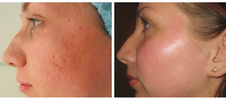 removing acne-on-the-face-and-calf-AWtjrRc.webp