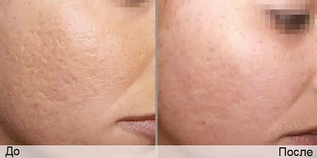 removendo acne no rosto e na panturrilha-GYOIi.webp