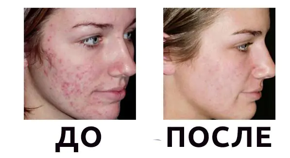 removendo acne-no-rosto-e-corpo-NmEsn.webp