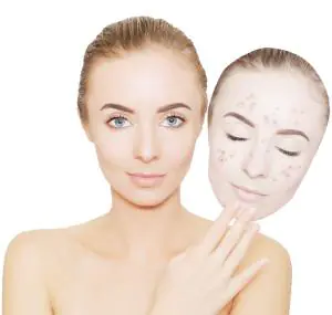 removing acne-on-the-face-and-body-ozzOR.webp