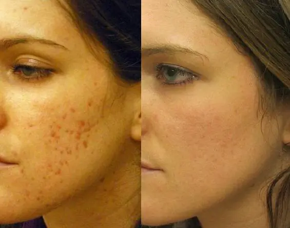 removing acne-on-the-face-and-body-xsPjKfD.webp