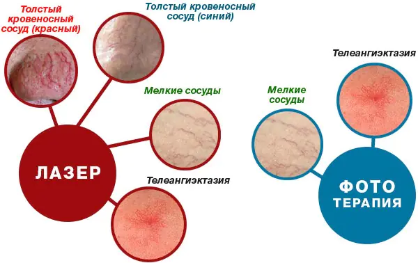 udalenie-kapillarov-na-lice-CYKHgE.webp