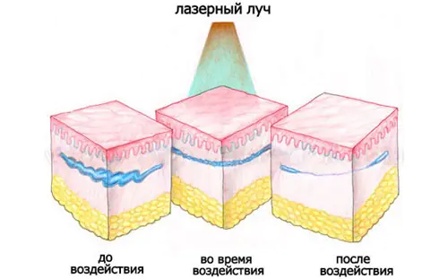 loại bỏ mao mạch trên má-NvKClWN.webp