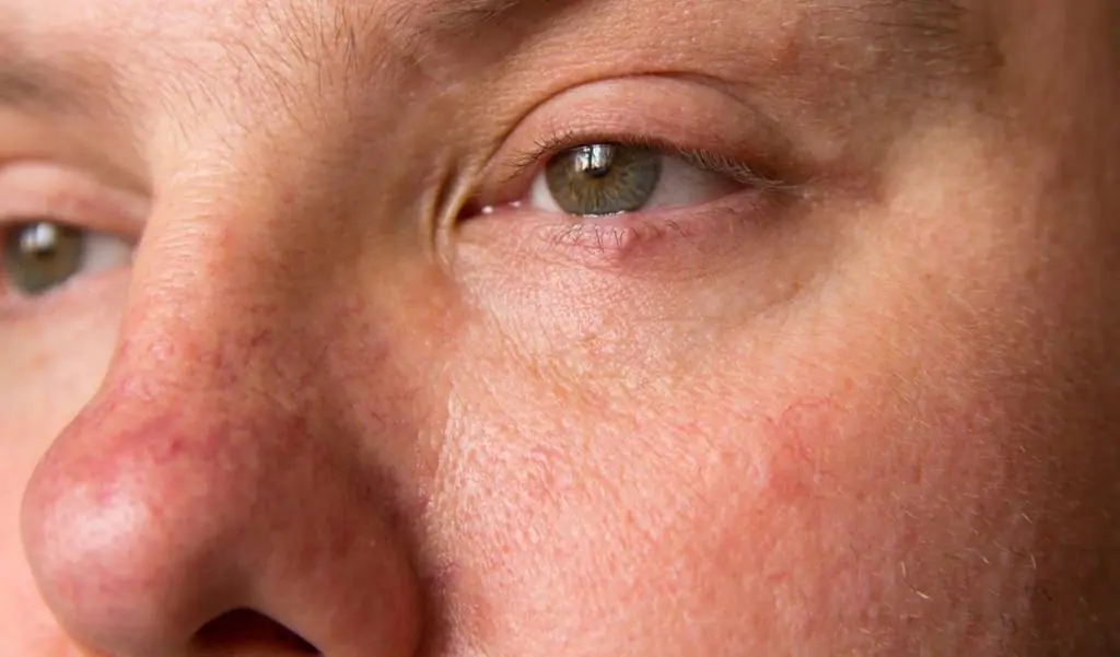 Rimozione dei capillari sul viso con revisioni laser
