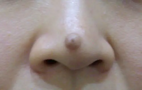 Removendo uma verruga na ponta do nariz