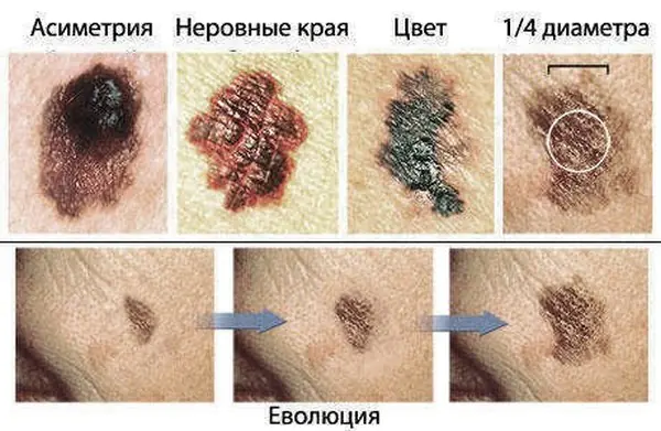 Mole removal what is the procedure called?