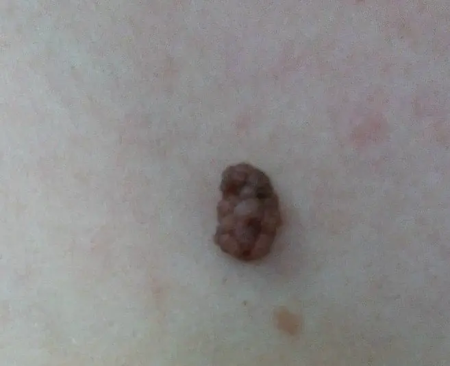Laser mole removal, will there be scars?
