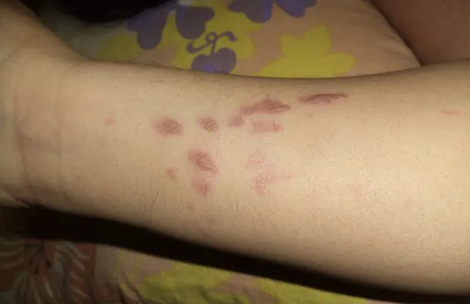 Removal of scars after burns