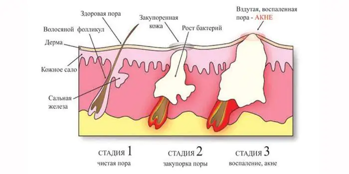 Угревая сыпь что делать