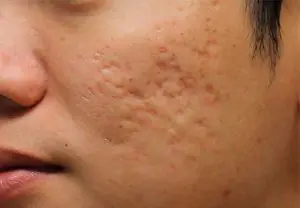 Acne on face treatment at home