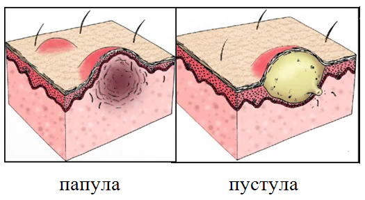 Угревая сыпь на спине причины и лечение