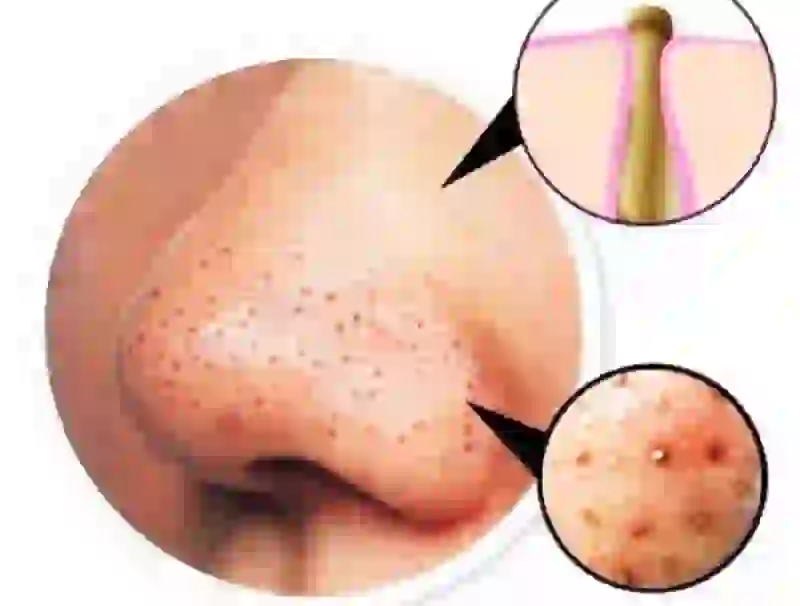 Acne blackheads how to get rid of