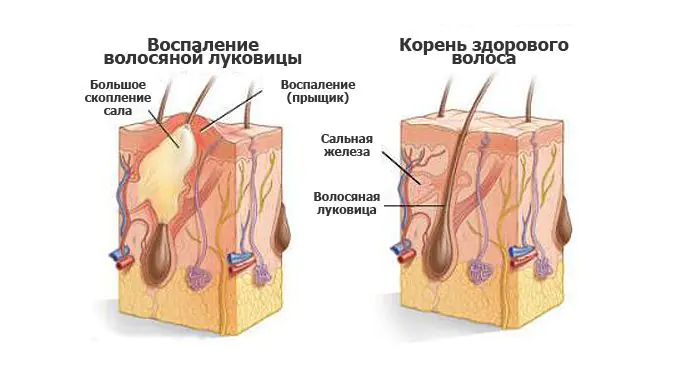 ugri-na-golove-v-volosah-u-Jqfui.webp