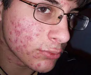 O que é acne no rosto?