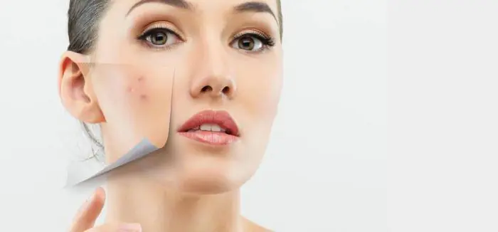 O que significa acne no rosto?