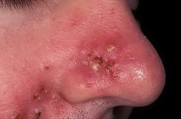 Příčiny akné na nose u mužů