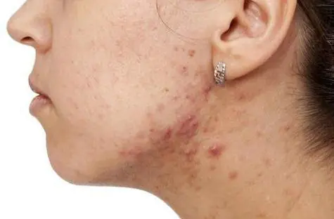 Causas da acne no pescoço em mulheres
