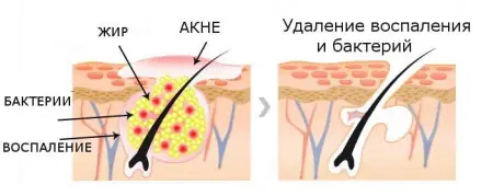 ugri-na-척추-사진-HmjaqMQ.webp