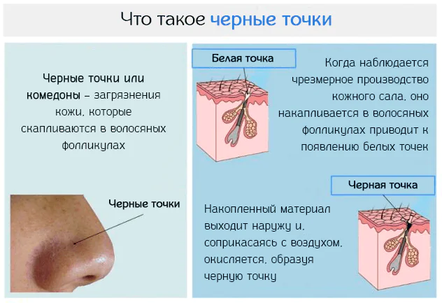 uhod-derrière-la-peau-joue-avec-acné-WeYQLjw.webp