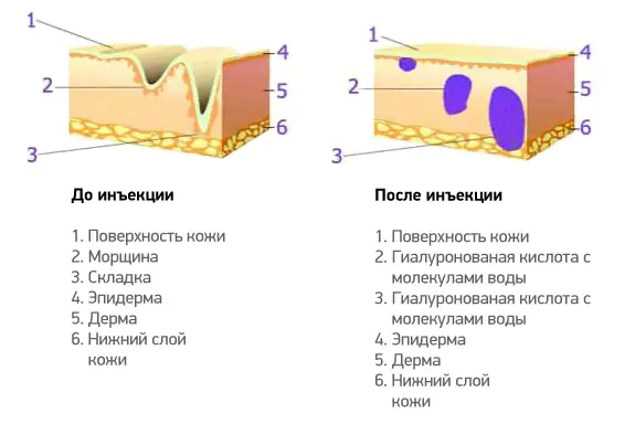 ukoly-gialuronovoj-kisloty-v-bunNdhx.webp