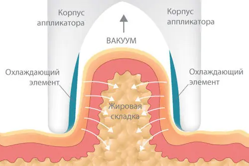 ultrazvuková-kavitaciya-v-KkwAGXC.webp