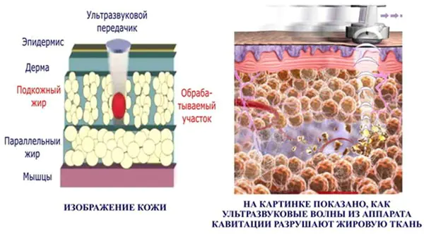 ultrazvuková-kavitaciya-v-iIdvFAe.webp